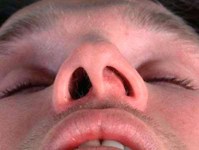 Mitos e verdades sobre o desvio de septo nasal